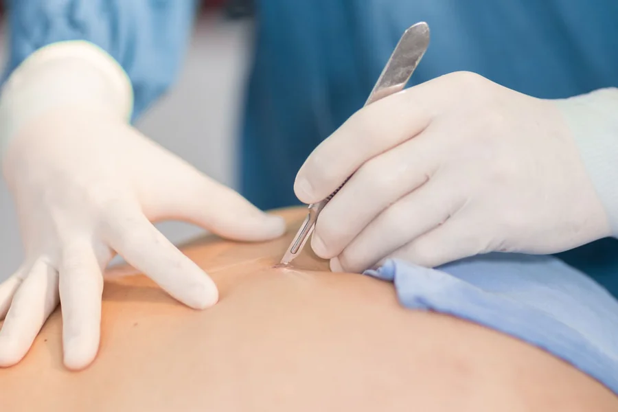 Lipoma Removal
